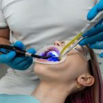 Tooth Fillings