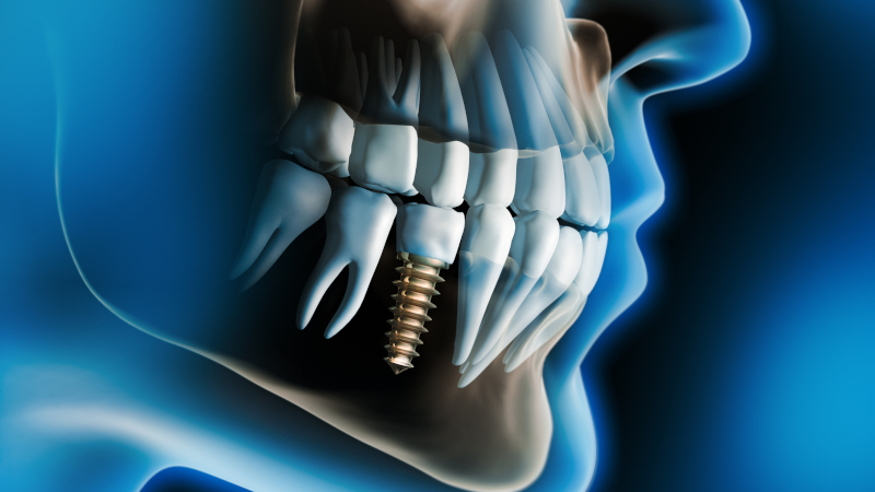 Dental Implants in Toronto, Ontario