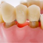 Dental Bridges