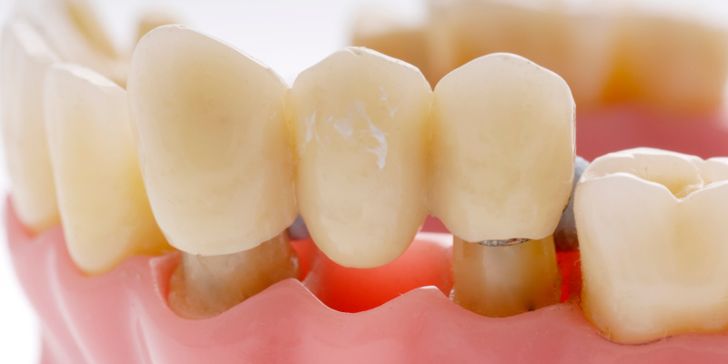 Dental Bridges in Toronto, Ontario