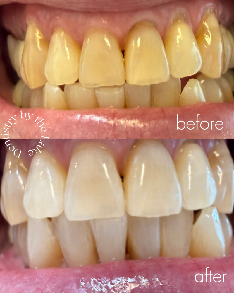 before and after whitening treatment