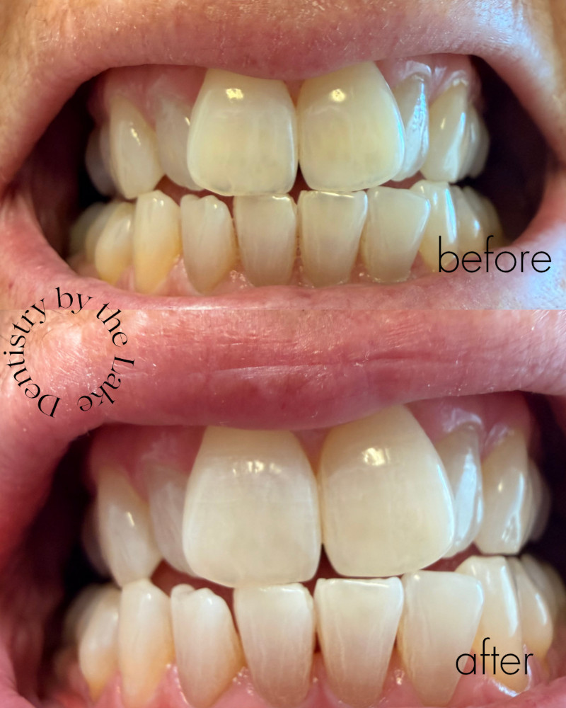 before and after whitening treatment