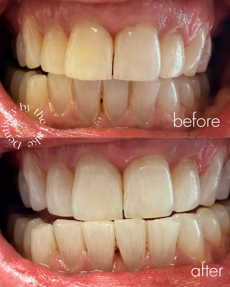 before and after whitening treatment